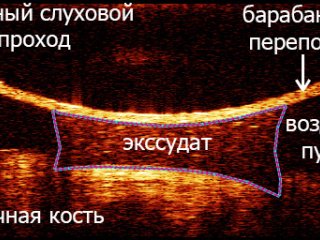 Оптический когерентный томограф для неинвазивного исследования среднего уха чел…