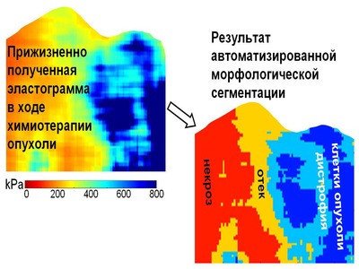 "Эласто-спектроскопия" для диагностики онкологических заболеваний