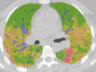 Новый программный модуль для оценки поражения легких при COVID-19 успешно проше…