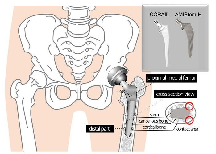 Ученые проанализировали изменения плотности костной ткани и контакт стержня с бедренной костью у 36 пациентов, использующих традиционные стержни (CORAIL), и у 30 пациентов, использующих новые (AMIStem-H). Фото: Yohei Ohyama /Osaka Metropolitan University