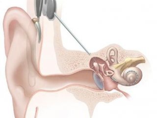 Нейроинженерия поможет глухим и слепым