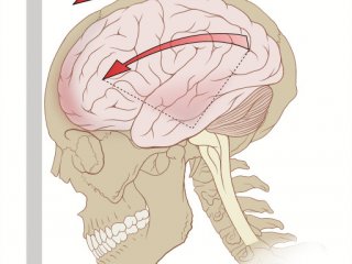 Названы четыре основных проявления сотрясения мозга
